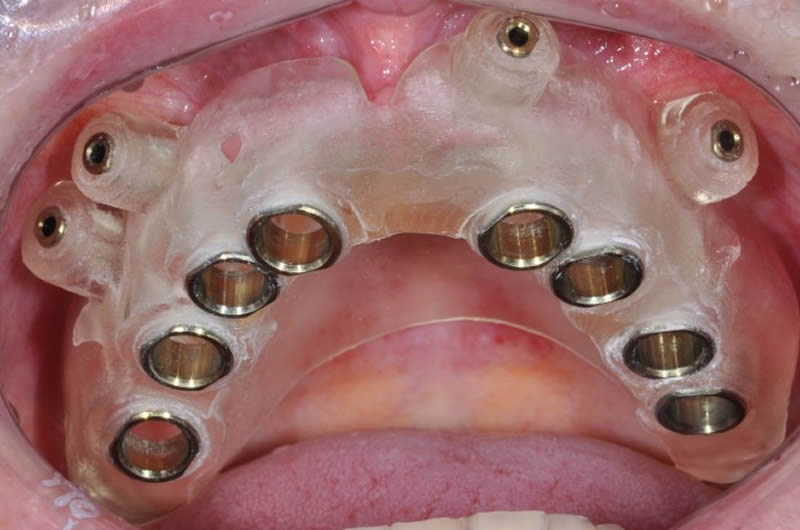 Guia Cirúrgica Prototipada em Boca