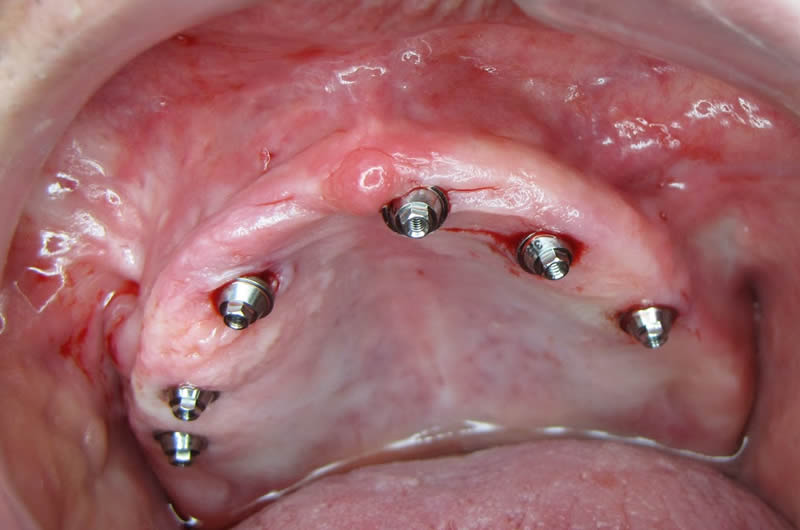Pós- Operatório Imediato