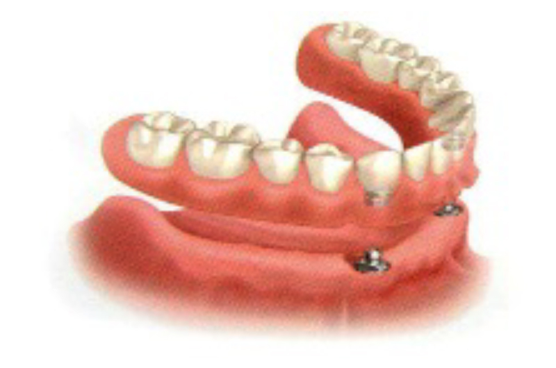 Prótese Overdenture